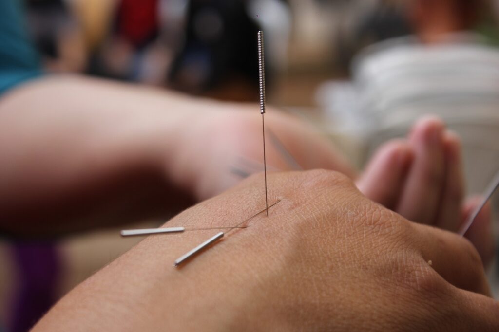 Acupuncture Services